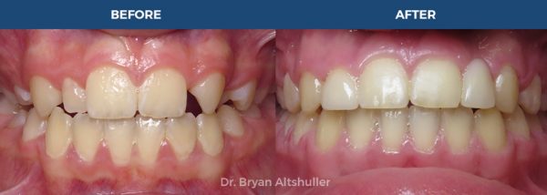 DR BRYAN ALTSHULLER Orthodontic Clinic / Before After