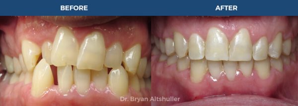 Clear braces / clearcorrect braces before and after image